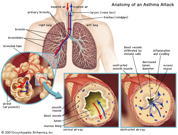 bronchial-asthma