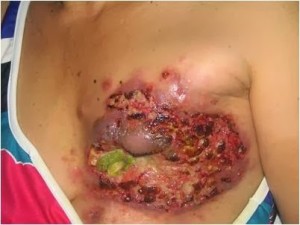 cara-mengobati-tumor-payudara-300x225